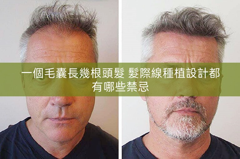 一個毛囊長幾根頭髮 髮際線種植設計都有哪些禁忌 一個毛囊長幾根頭髮 髮際線種植設計都有哪些禁忌