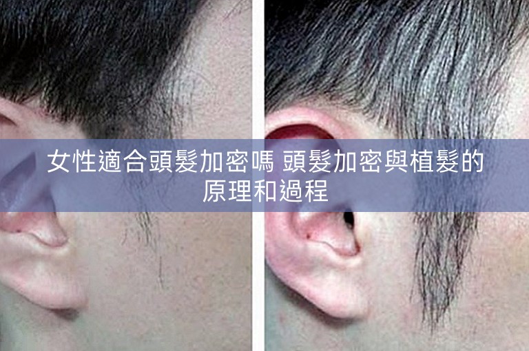 女性適合頭髮加密嗎 頭髮加密與植髮的原理和過程