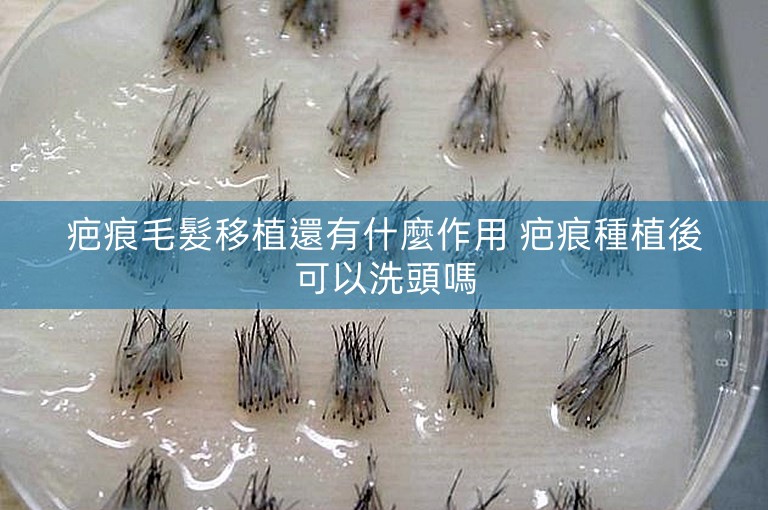 疤痕毛髮移植還有什麼作用 疤痕種植後可以洗頭嗎