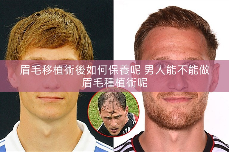 眉毛移植術後如何保養呢 男人能不能做眉毛種植術呢