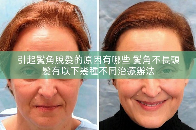 引起鬢角脫髮的原因有哪些 鬢角不長頭髮有以下幾種不同治療辦法