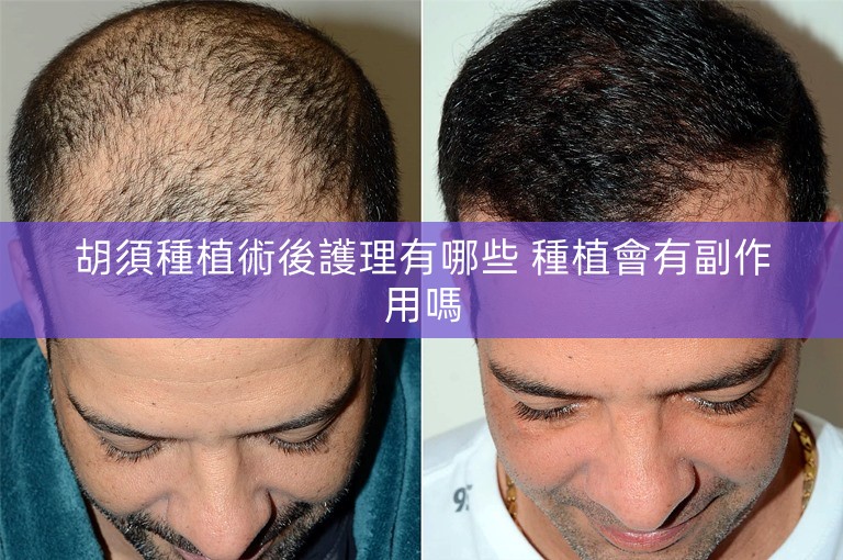 胡須種植術後護理有哪些 種植會有副作用嗎