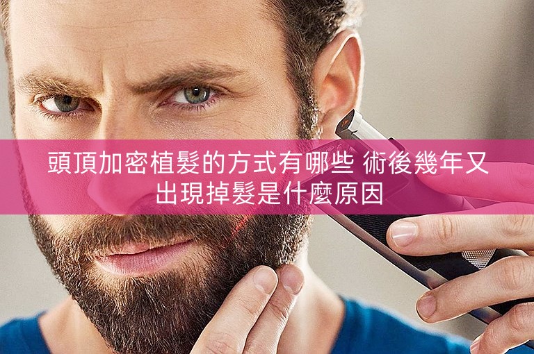 頭頂加密植髮的方式有哪些 術後幾年又出現掉髮是什麼原因