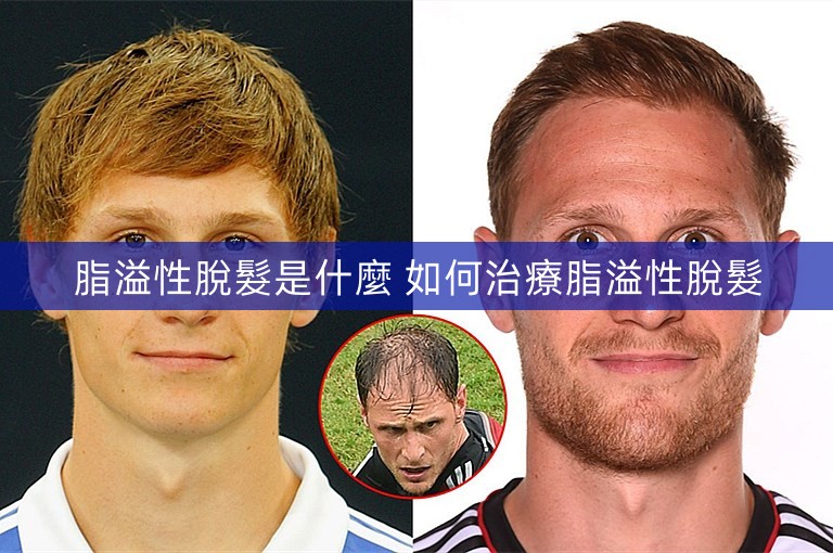 脂溢性脫髮是什麼 如何治療脂溢性脫髮 脂溢性脫髮是什麼 如何治療脂溢性脫髮