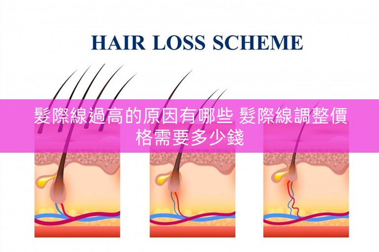 髮際線過高的原因有哪些 髮際線調整價格需要多少錢