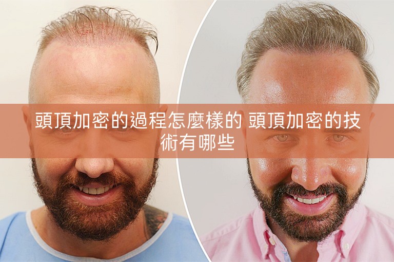 頭頂加密的過程怎麼樣的 頭頂加密的技術有哪些