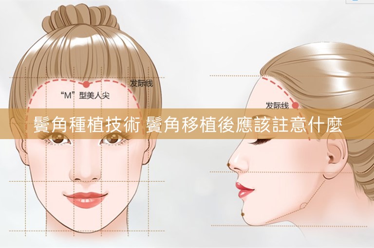 鬢角種植技術 鬢角移植後應該註意什麼