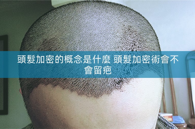 頭髮加密的概念是什麼 頭髮加密術會不會留疤