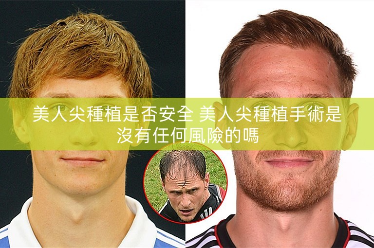 美人尖種植是否安全 美人尖種植手術是沒有任何風險的嗎