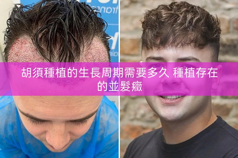 胡須種植的生長周期需要多久 種植存在的並髮癥