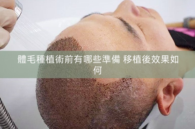 體毛種植術前有哪些準備 移植後效果如何