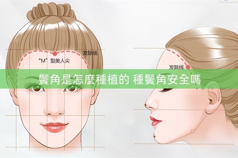 鬢角是怎麼種植的 種鬢角安全嗎