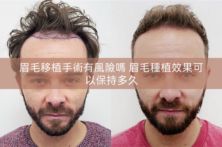 眉毛移植手術有風險嗎 眉毛種植效果可以保持多久