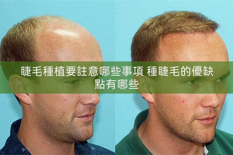 睫毛種植要註意哪些事項 種睫毛的優缺點有哪些