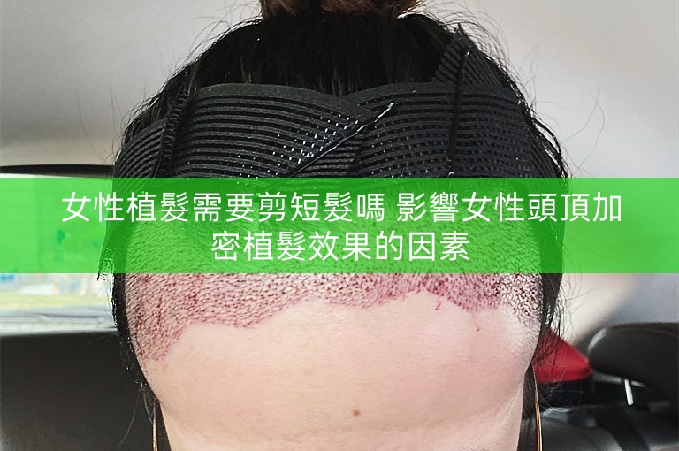 女性植髮需要剪短髮嗎 影響女性頭頂加密植髮效果的因素