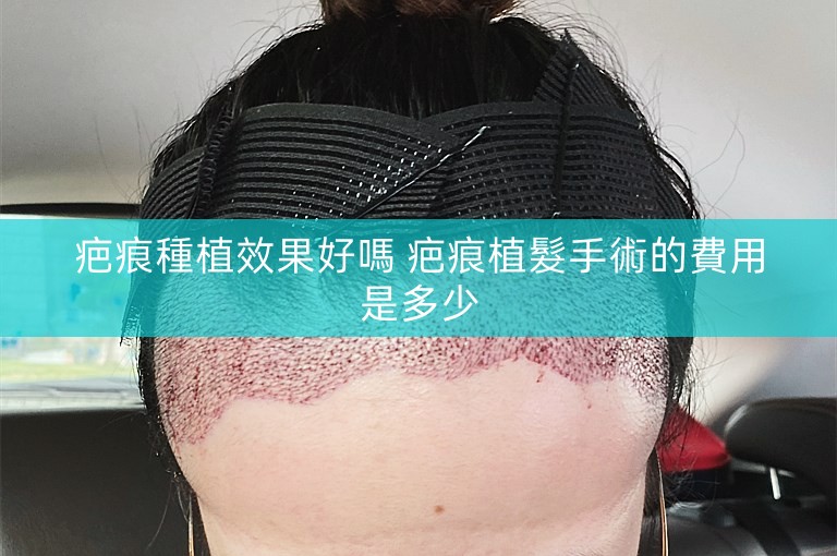 疤痕種植效果好嗎 疤痕植髮手術的費用是多少