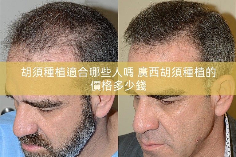 胡須種植適合哪些人嗎 廣西胡須種植的價格多少錢