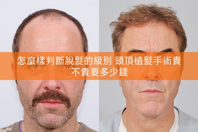 怎麼樣判斷脫髮的級別 頭頂植髮手術貴不貴要多少錢
