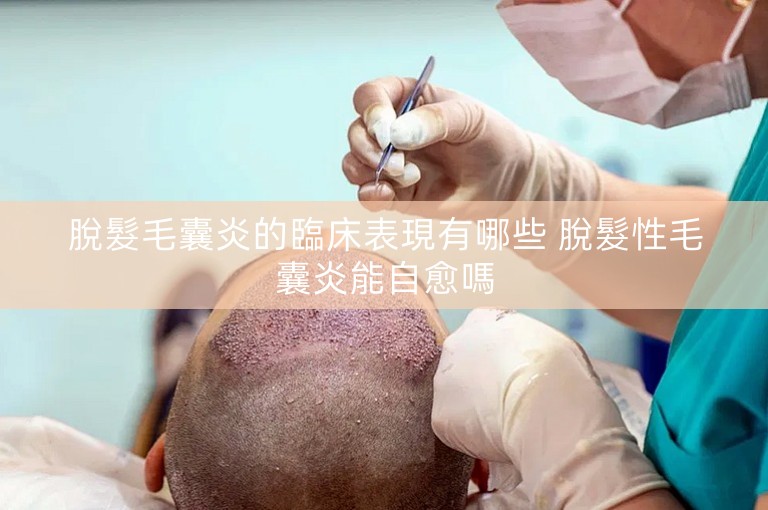 脫髮毛囊炎的臨床表現有哪些 脫髮性毛囊炎能自愈嗎