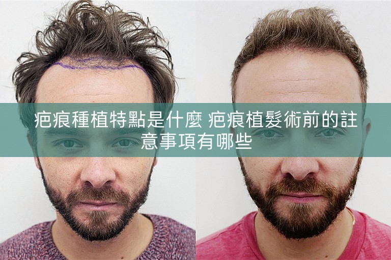 疤痕種植特點是什麼 疤痕植髮術前的註意事項有哪些