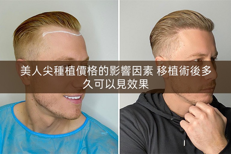 美人尖種植價格的影響因素 移植術後多久可以見效果