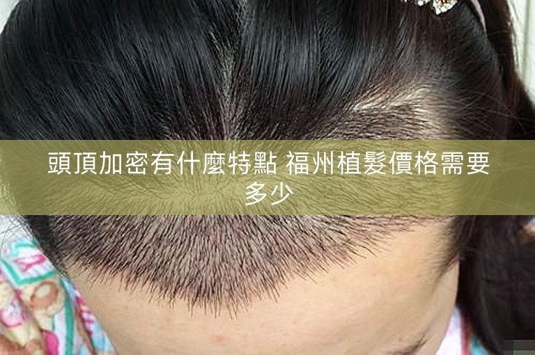 頭頂加密有什麼特點 福州植髮價格需要多少