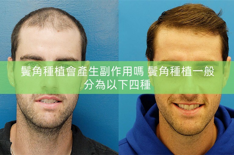 鬢角種植會產生副作用嗎 鬢角種植一般分為以下四種
