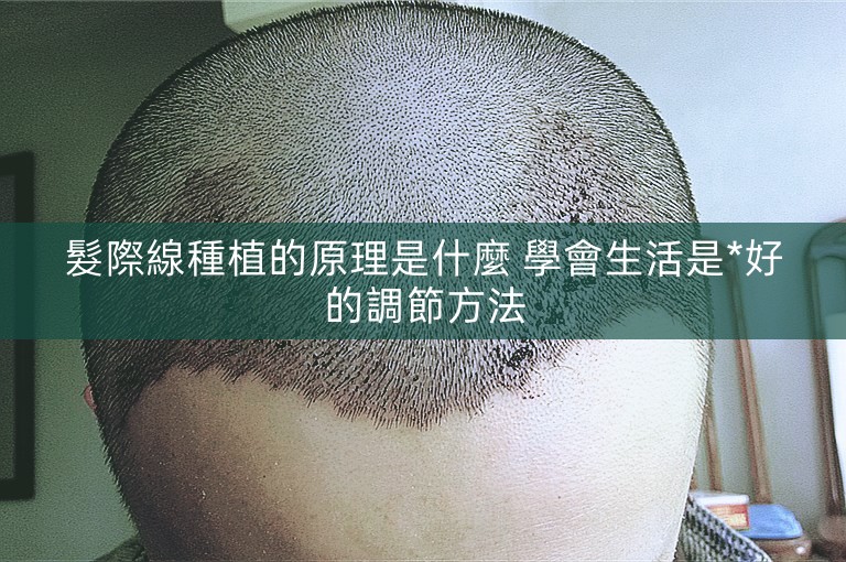 髮際線種植的原理是什麼 學會生活是*好的調節方法