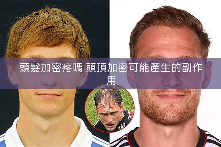 頭髮加密疼嗎 頭頂加密可能產生的副作用