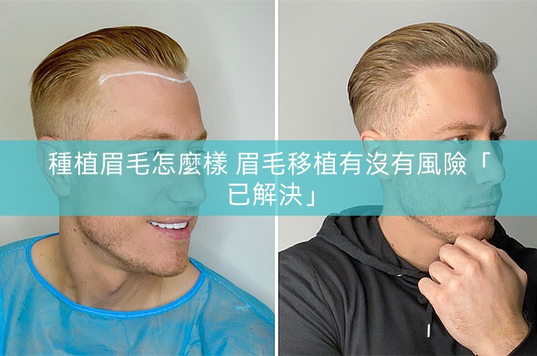 種植眉毛怎麼樣 眉毛移植有沒有風險「已解決」
