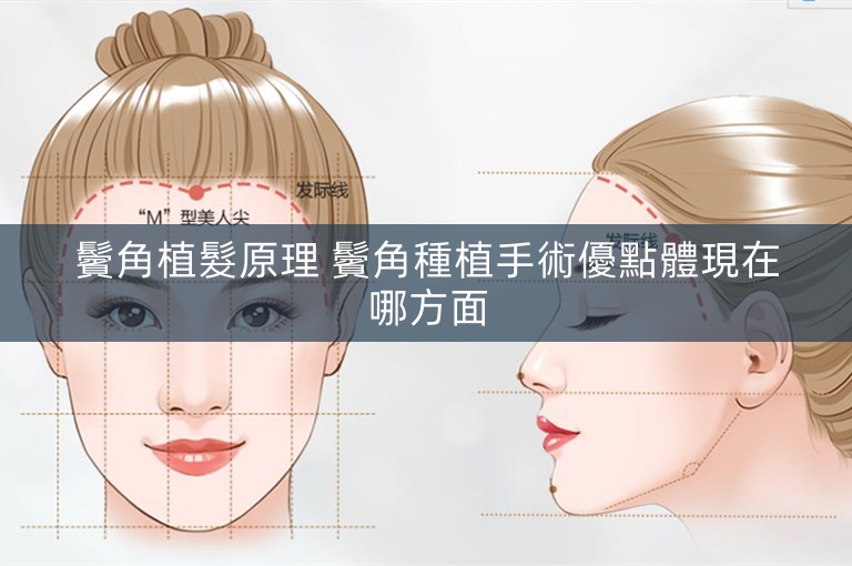 鬢角植髮原理 鬢角種植手術優點體現在哪方面