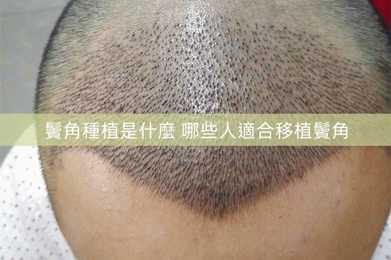 鬢角種植是什麼 哪些人適合移植鬢角