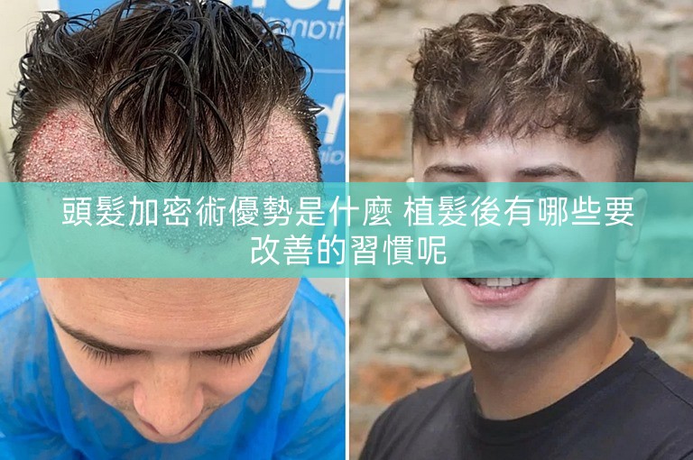頭髮加密術優勢是什麼 植髮後有哪些要改善的習慣呢