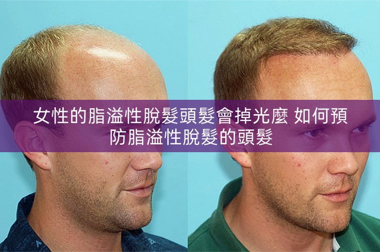 女性的脂溢性脫髮頭髮會掉光麼 如何預防脂溢性脫髮的頭髮