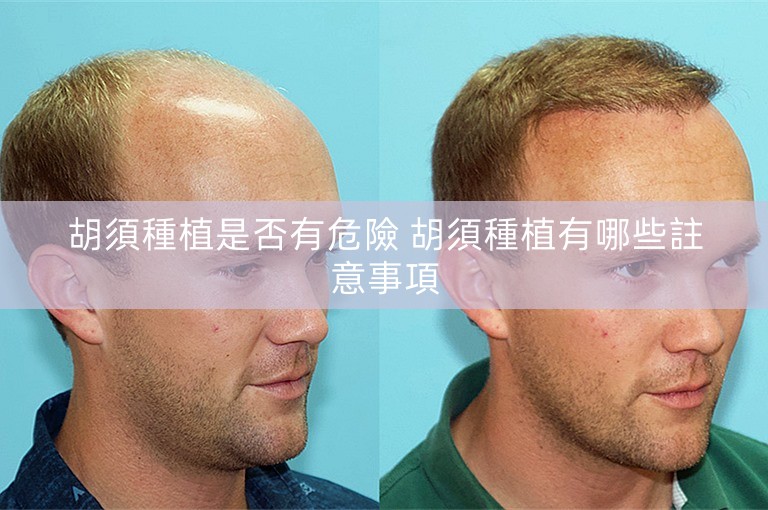 胡須種植是否有危險 胡須種植有哪些註意事項