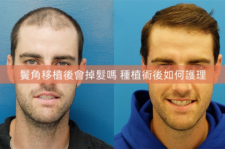 鬢角移植後會掉髮嗎 種植術後如何護理