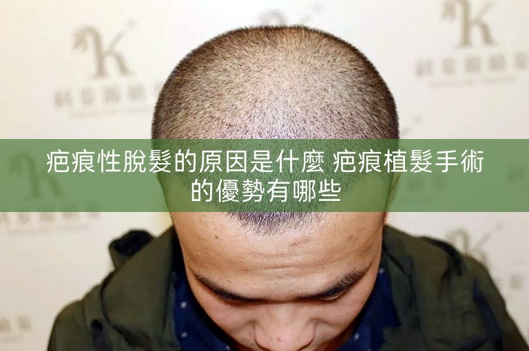 疤痕性脫髮的原因是什麼 疤痕植髮手術的優勢有哪些