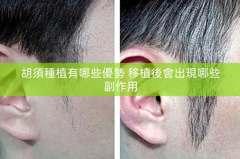 胡須種植有哪些優勢 移植後會出現哪些副作用