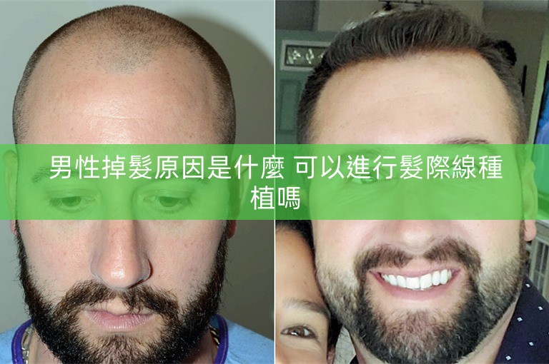 男性掉髮原因是什麼 可以進行髮際線種植嗎