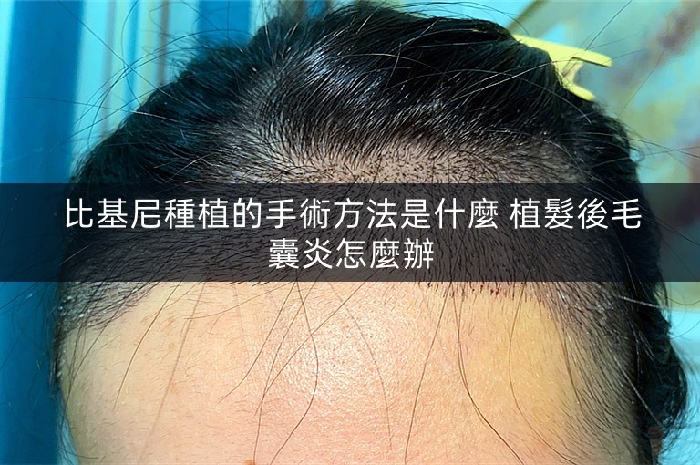 比基尼種植的手術方法是什麼 植髮後毛囊炎怎麼辦