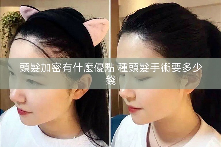 頭髮加密有什麼優點 種頭髮手術要多少錢