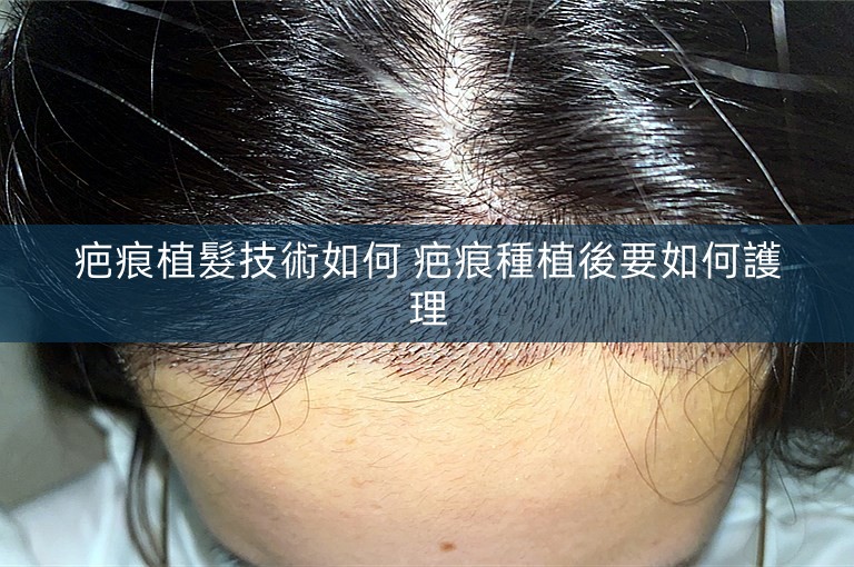 疤痕植髮技術如何 疤痕種植後要如何護理