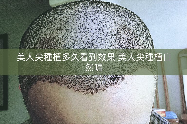 美人尖種植多久看到效果 美人尖種植自然嗎