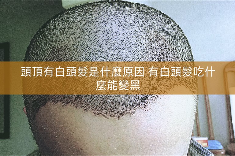 頭頂有白頭髮是什麼原因 有白頭髮吃什麼能變黑