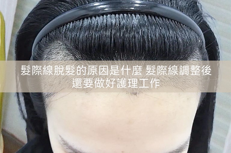 髮際線脫髮的原因是什麼 髮際線調整後還要做好護理工作