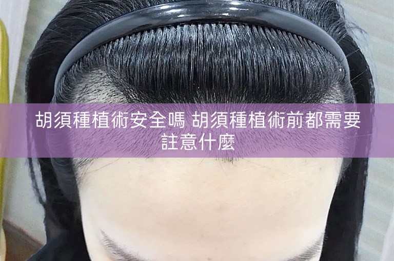 胡須種植術安全嗎 胡須種植術前都需要註意什麼 胡須種植術安全嗎 胡須種植術前都需要註意什麼