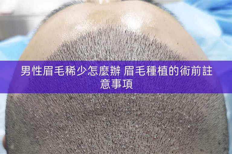 男性眉毛稀少怎麼辦 眉毛種植的術前註意事項