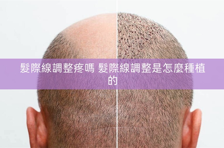 髮際線調整疼嗎 髮際線調整是怎麼種植的