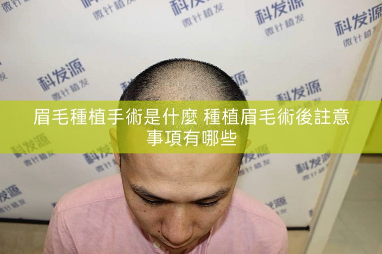 眉毛種植手術是什麼 種植眉毛術後註意事項有哪些