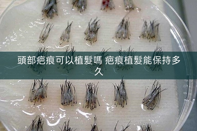 頭部疤痕可以植髮嗎 疤痕植髮能保持多久